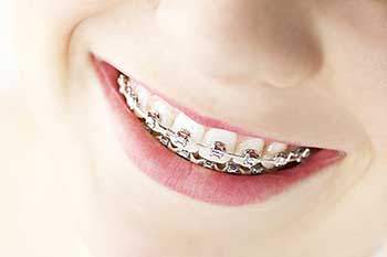 Braces