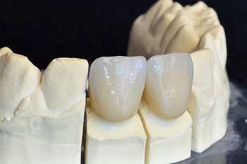 Ceramic Crowns